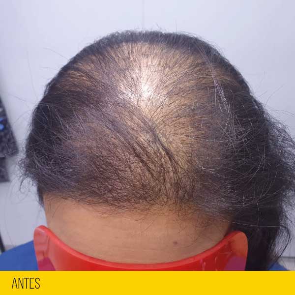 mujer con alopecia antes