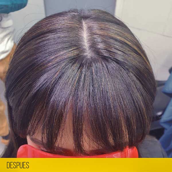 mujer con alopecia despues