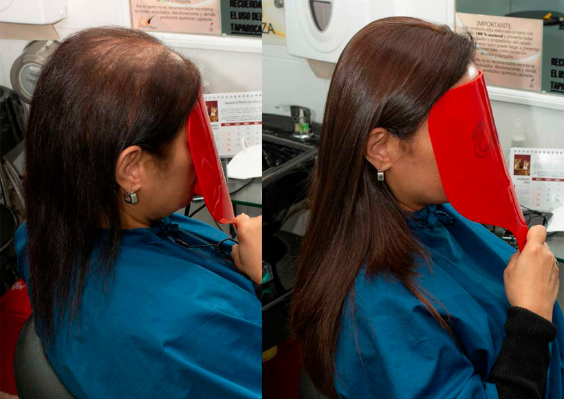 protesis capilar con piel superior