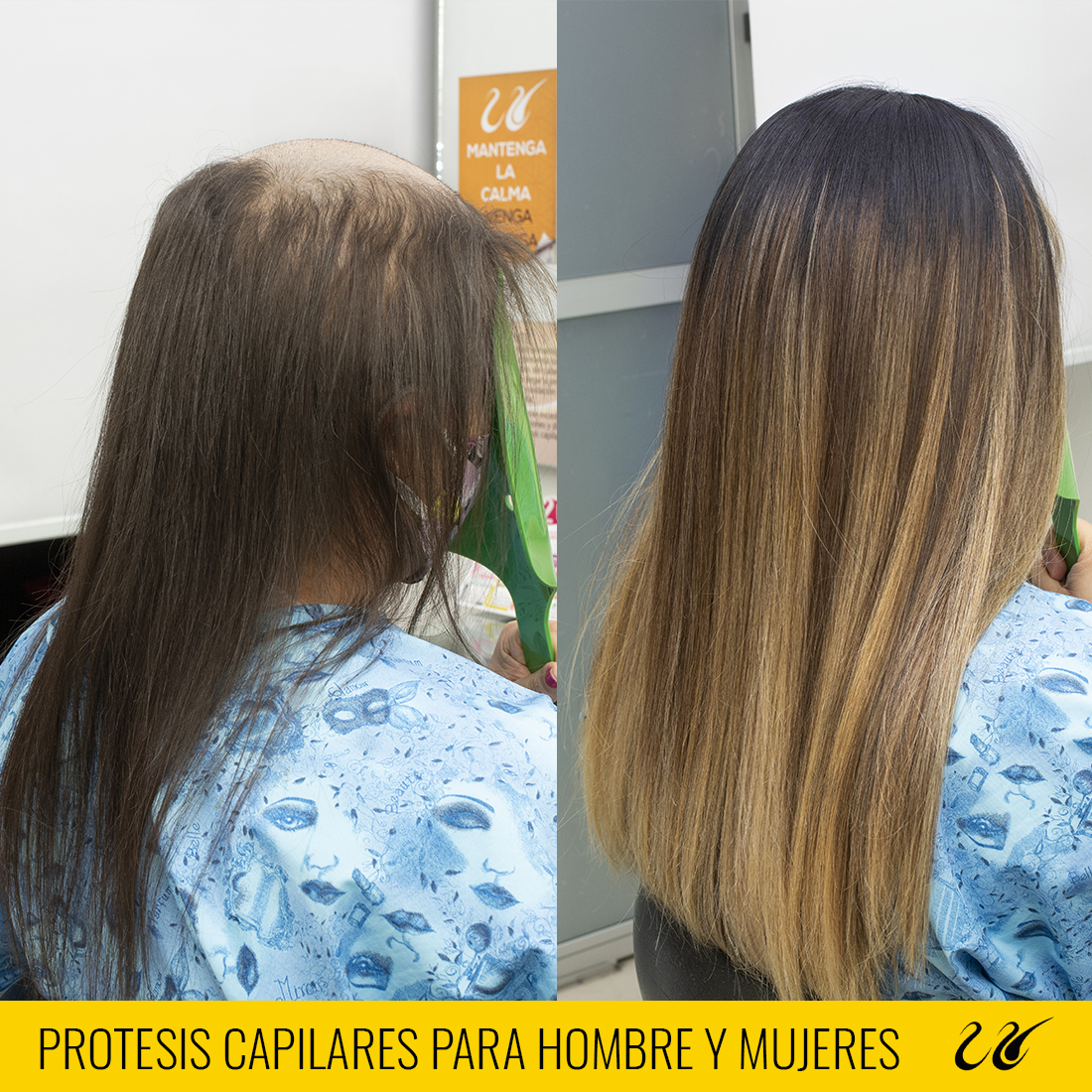 protesis de capilares para hombres y mujeres