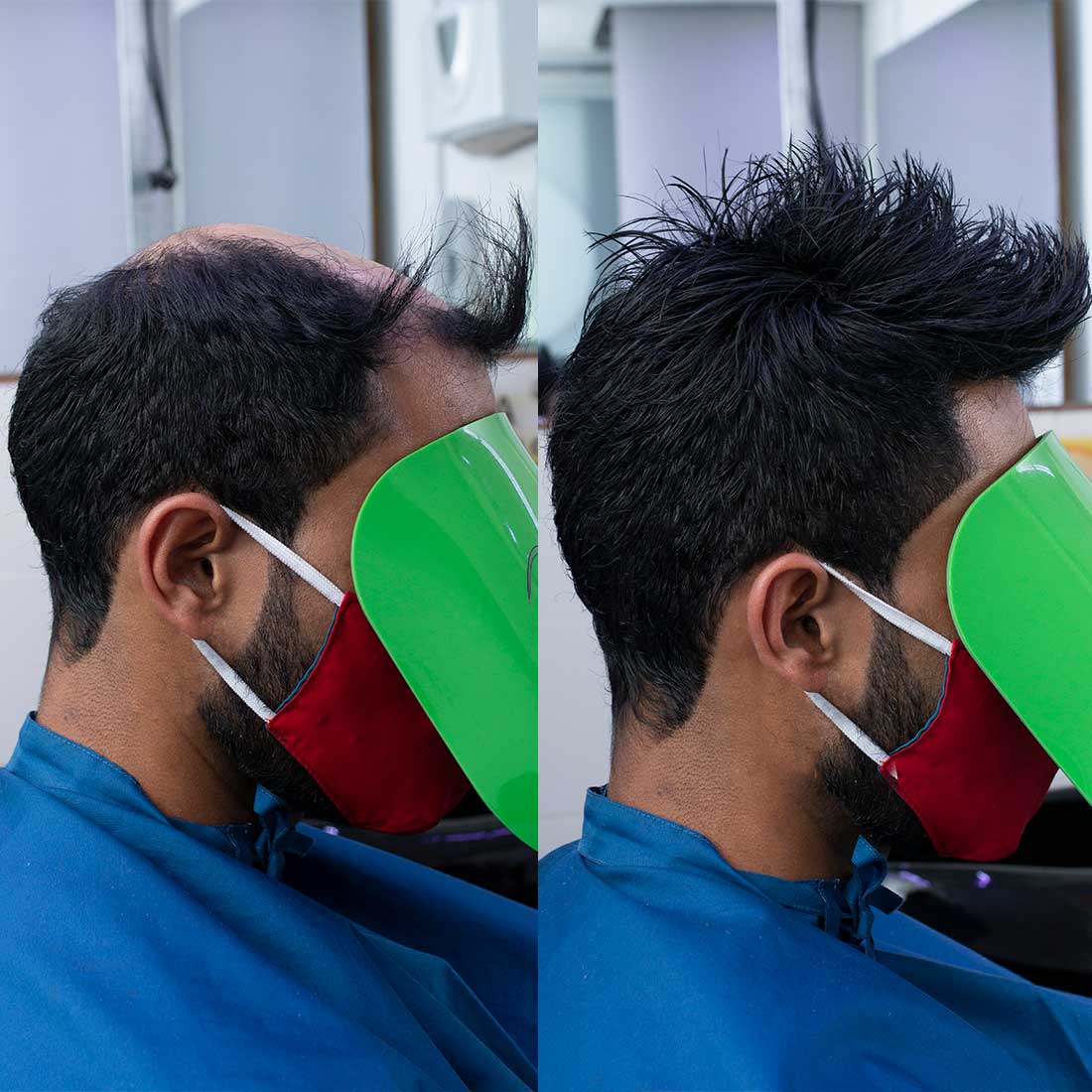 protesis para hombre