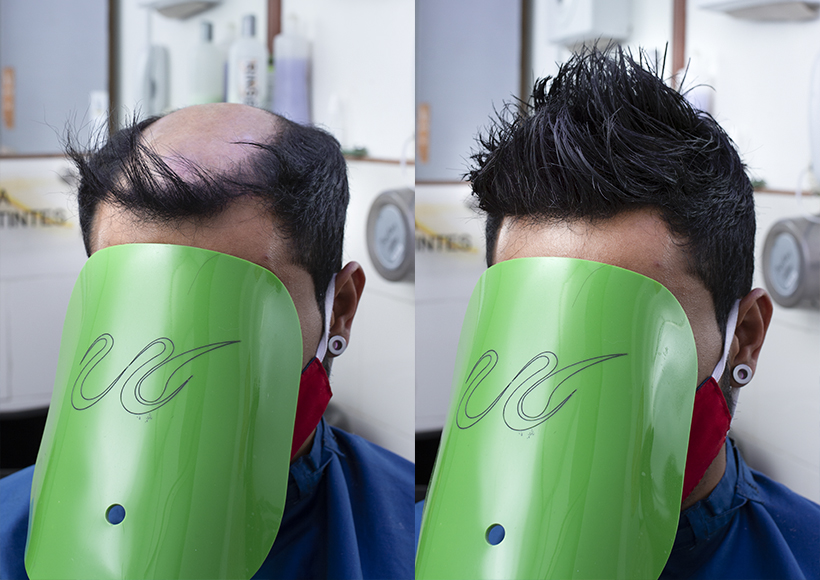 protesis de hombre piel superior