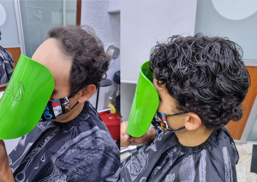 protesis que tapa los tatuajes