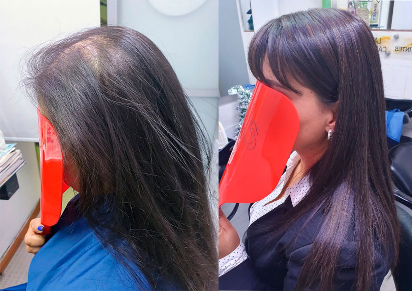 protesis de mujer alopecia androgenetica