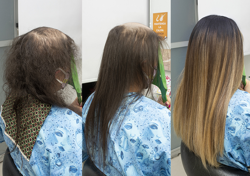 alisado mas protesis